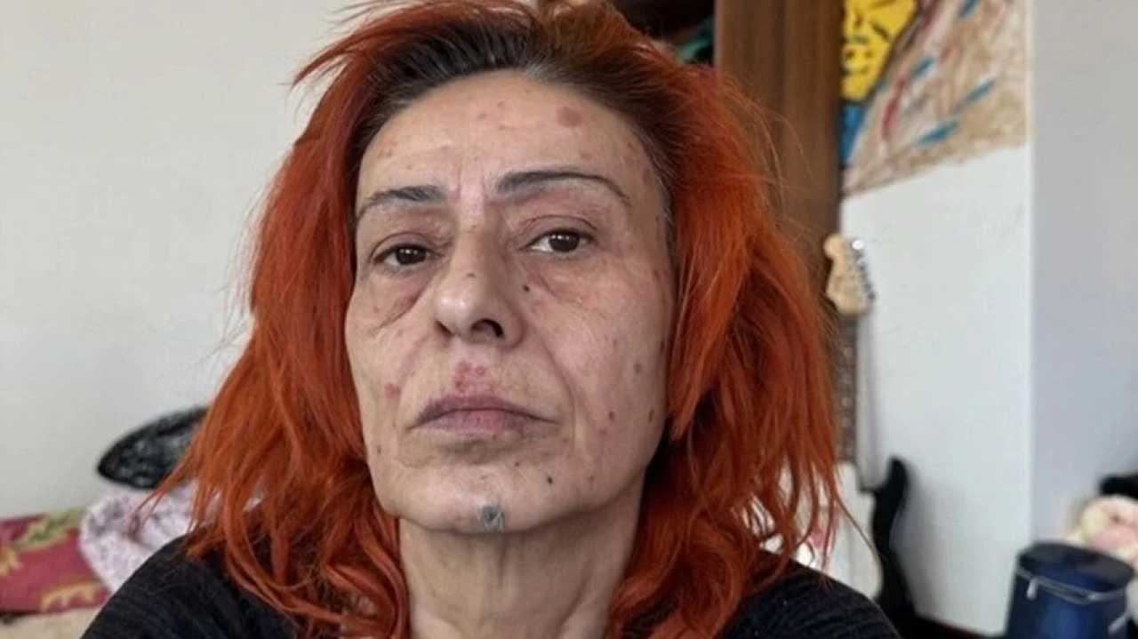 Yüzündeki izler korkuttu! Yıldız Tilbe’nin son hali sevenlerini üzdü